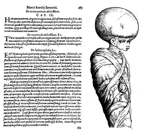 severino 5yr boy hydrocephalus